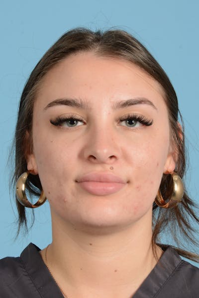 Rhinoplasty Before & After Gallery - Patient 916916 - Image 2