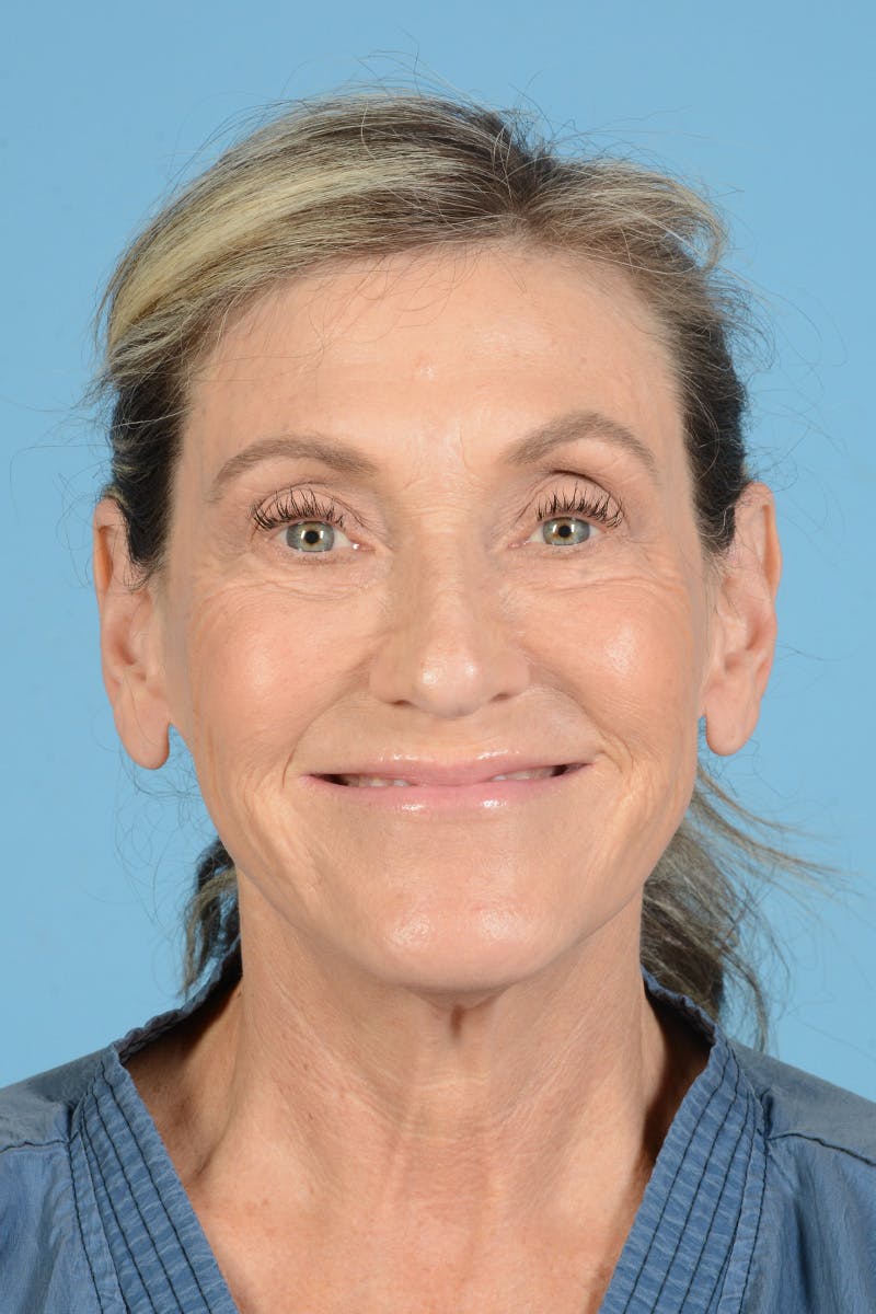 Facial Augmentation Before & After Gallery - Patient 777196 - Image 3