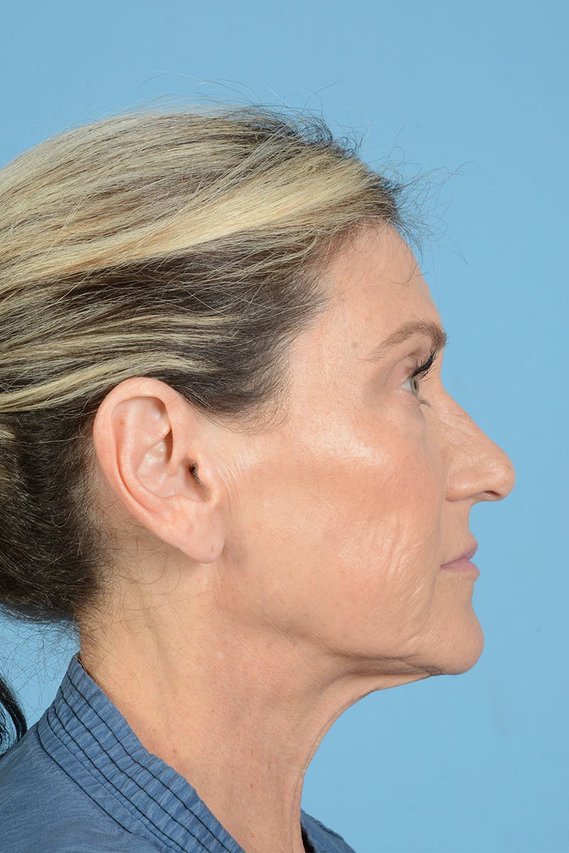 Facial Augmentation Before & After Gallery - Patient 777196 - Image 7
