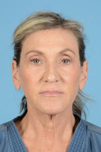 Facial Augmentation Before & After Gallery - Patient 777196 - Image 1