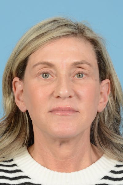 Facial Augmentation Before & After Gallery - Patient 777196 - Image 2
