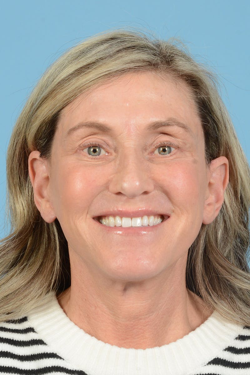 Facial Augmentation Before & After Gallery - Patient 777196 - Image 4