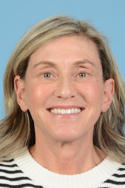 Facial Augmentation Before & After Gallery - Patient 777196 - Image 4