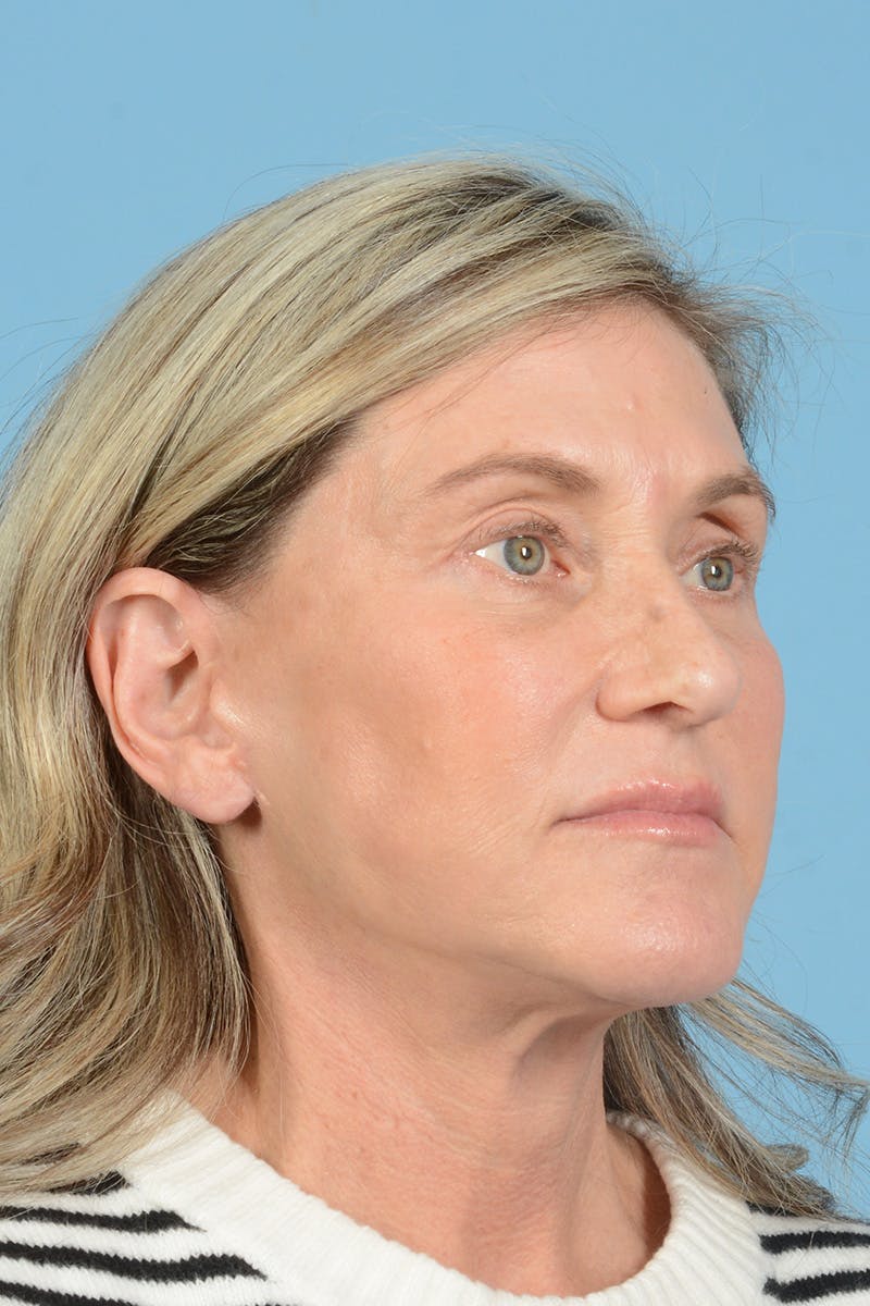 Facial Augmentation Before & After Gallery - Patient 777196 - Image 6