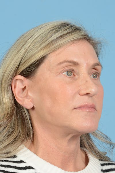 Facial Augmentation Before & After Gallery - Patient 777196 - Image 6