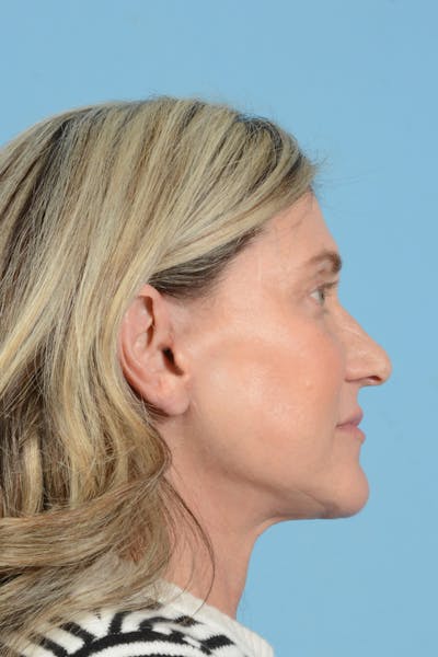 Facial Augmentation Before & After Gallery - Patient 777196 - Image 8