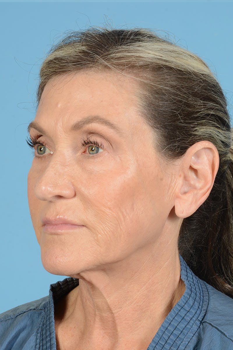 Facial Augmentation Before & After Gallery - Patient 777196 - Image 9