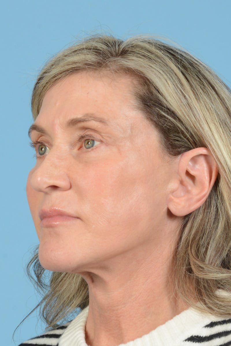 Facial Augmentation Before & After Gallery - Patient 777196 - Image 10