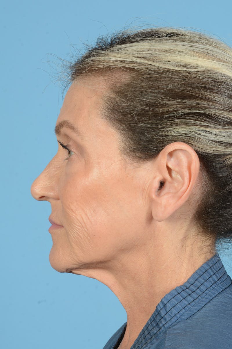 Facial Augmentation Before & After Gallery - Patient 777196 - Image 11