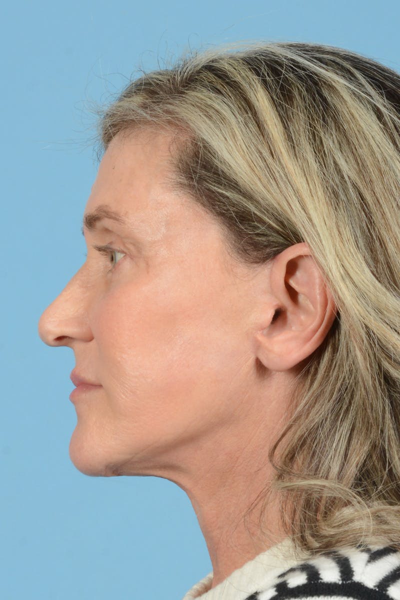 Facial Augmentation Before & After Gallery - Patient 777196 - Image 12