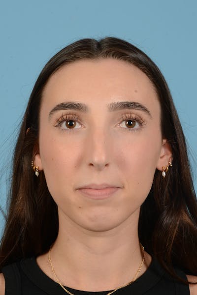 Rhinoplasty Before & After Gallery - Patient 138963 - Image 1