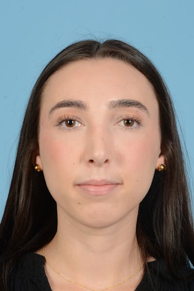 Rhinoplasty Before & After Gallery - Patient 138963 - Image 2