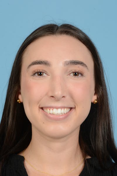 Rhinoplasty Before & After Gallery - Patient 138963 - Image 4