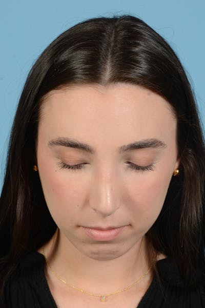 Rhinoplasty Before & After Gallery - Patient 138963 - Image 6