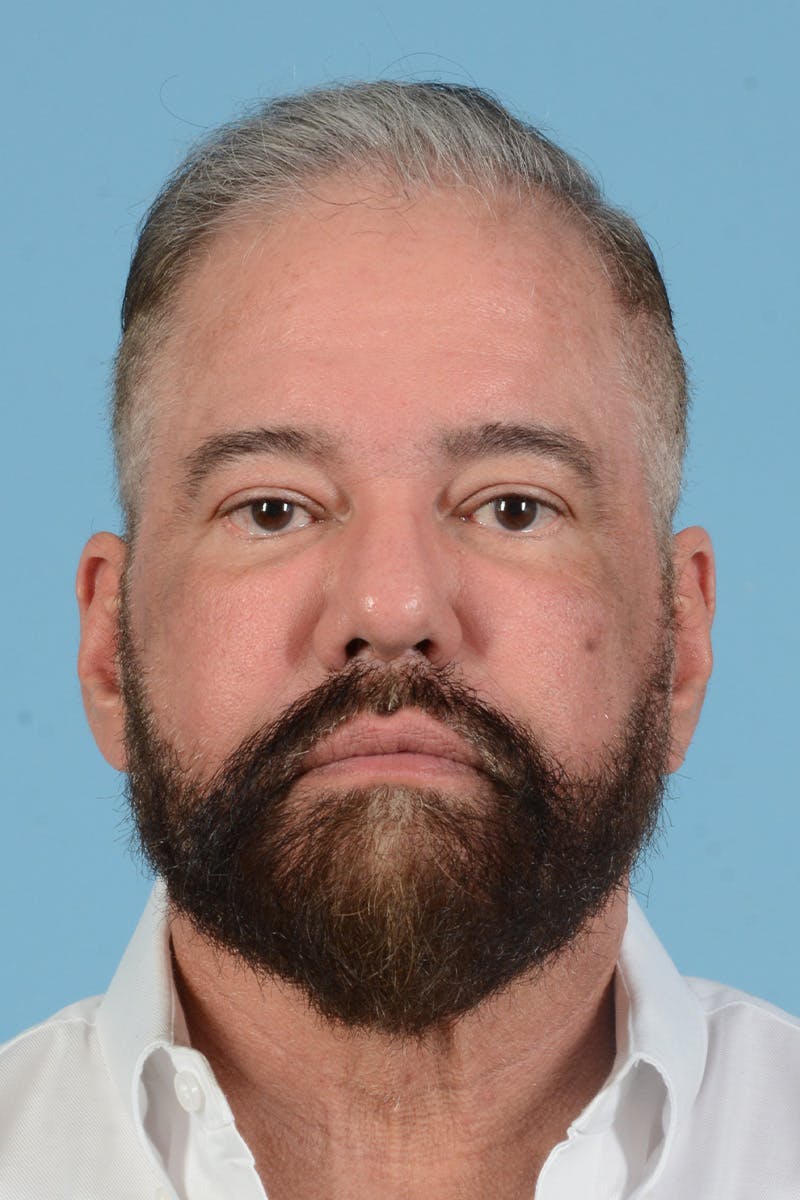 Facial Augmentation Before & After Gallery - Patient 172687 - Image 2