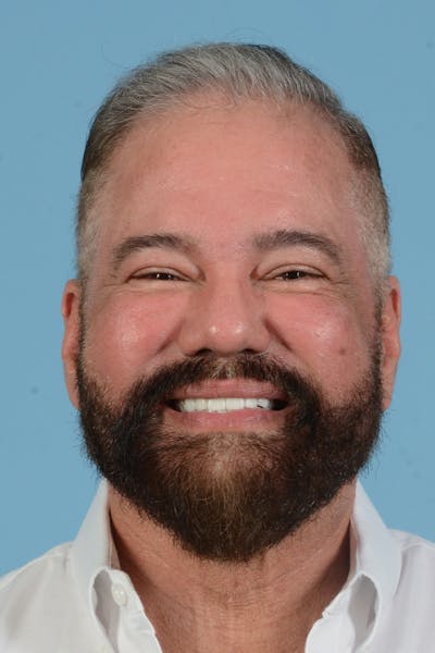 Facial Augmentation Before & After Gallery - Patient 172687 - Image 4