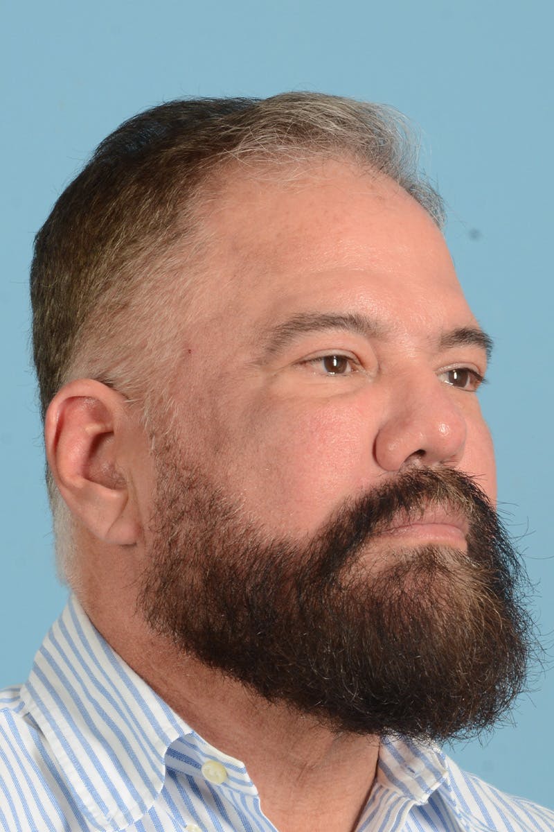 Facial Augmentation Before & After Gallery - Patient 172687 - Image 5