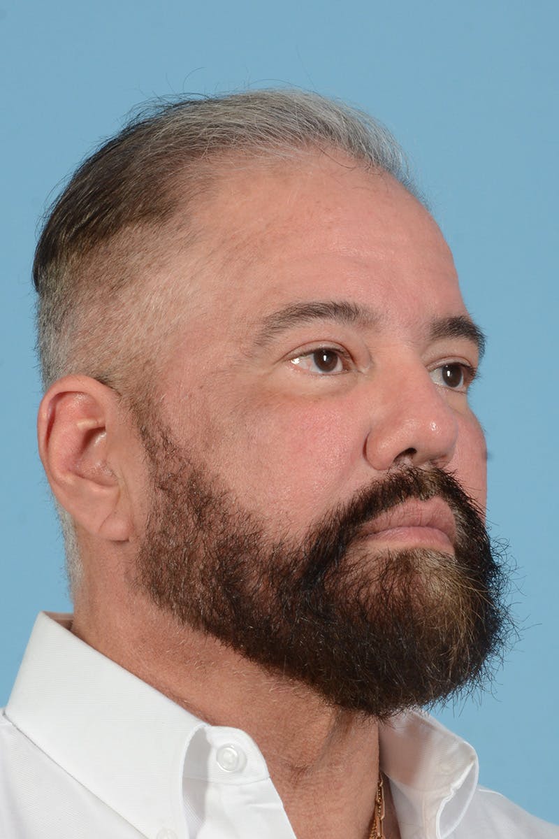 Facial Augmentation Before & After Gallery - Patient 172687 - Image 6