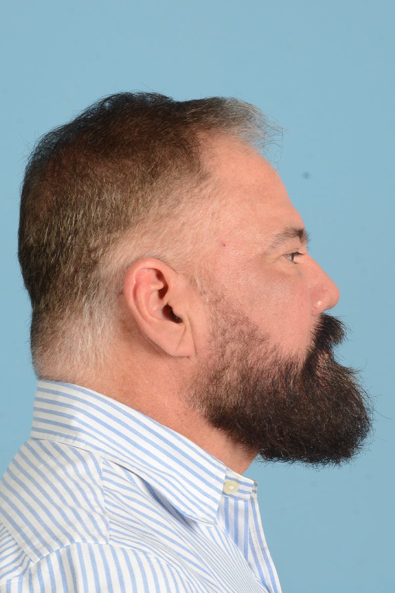 Facial Augmentation Before & After Gallery - Patient 172687 - Image 7