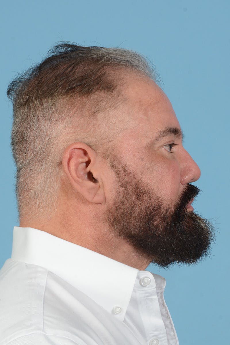 Facial Augmentation Before & After Gallery - Patient 172687 - Image 8