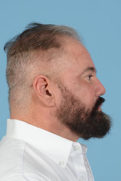 Facial Augmentation Before & After Gallery - Patient 172687 - Image 8