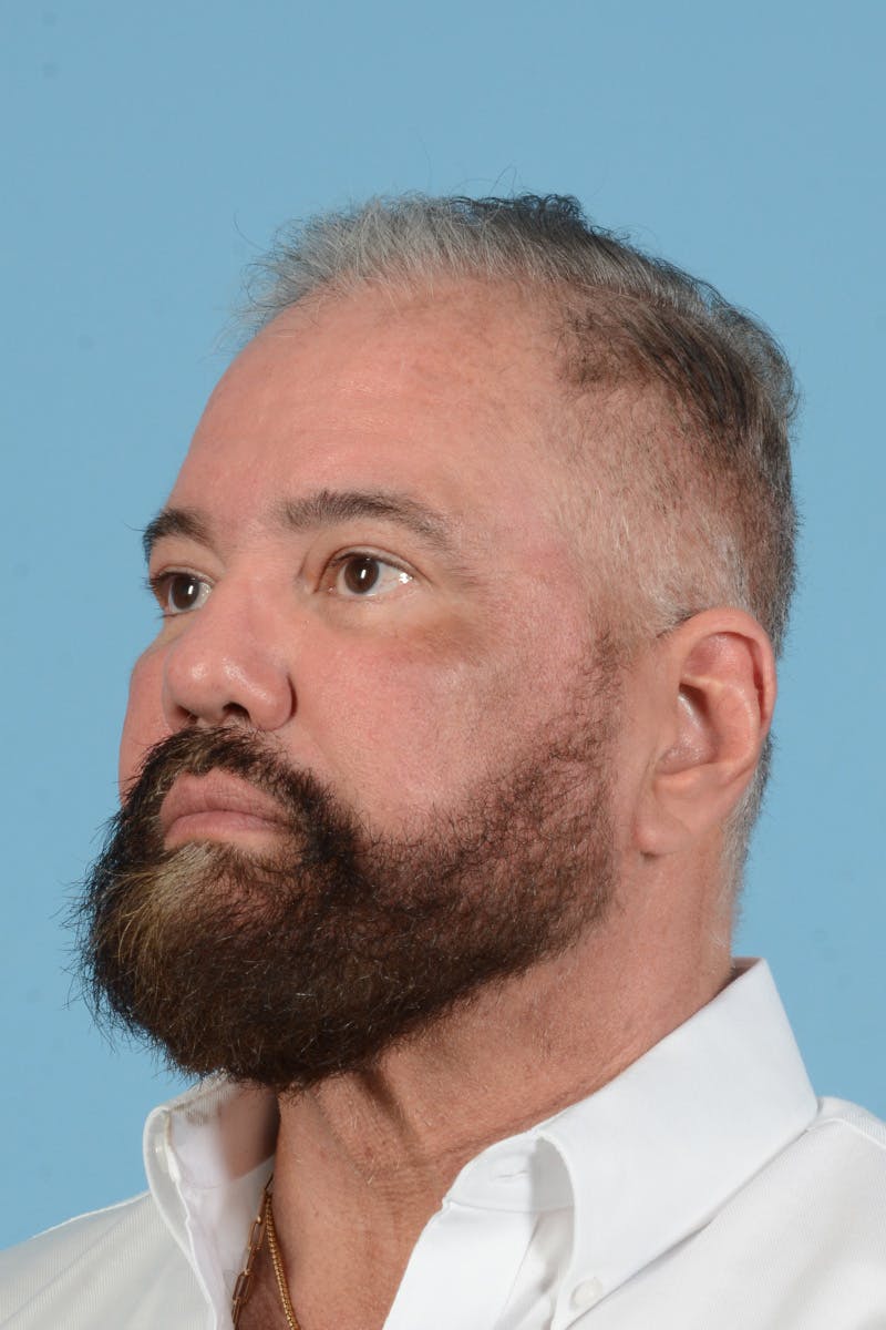 Facial Augmentation Before & After Gallery - Patient 172687 - Image 10