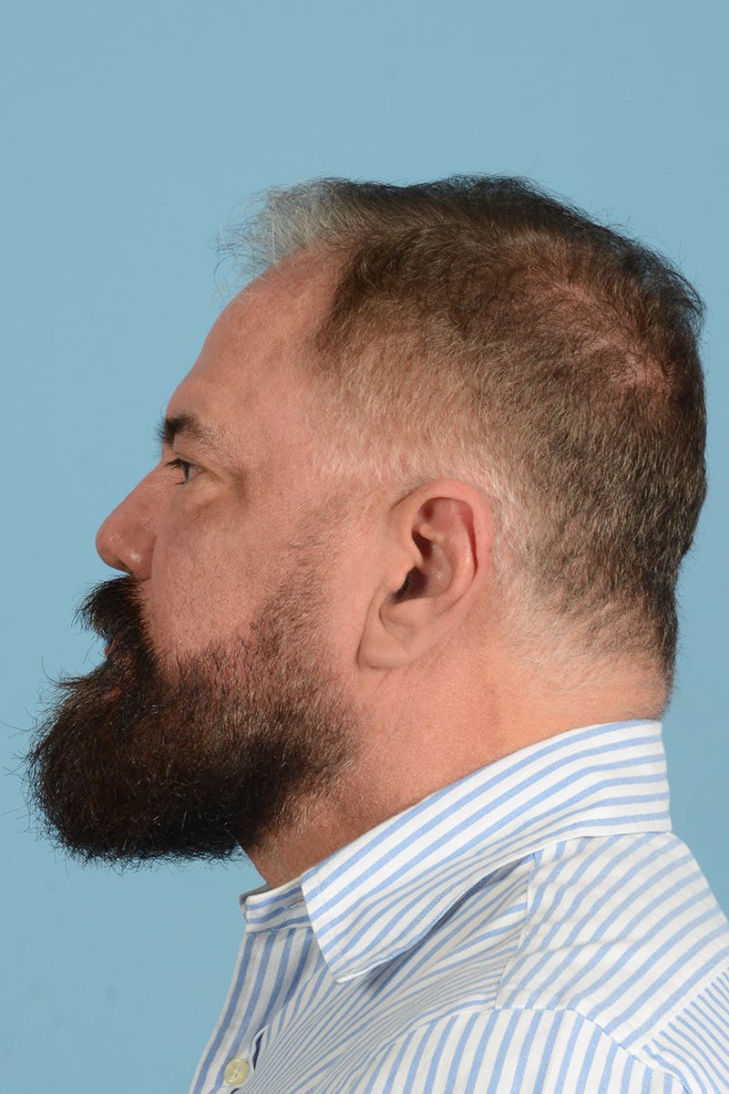 Facial Augmentation Before & After Gallery - Patient 172687 - Image 11