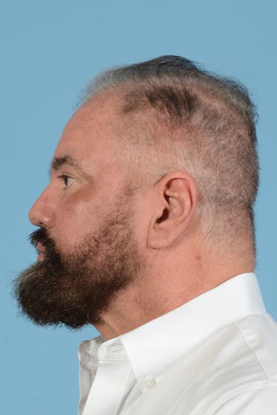 Facial Augmentation Before & After Gallery - Patient 172687 - Image 12