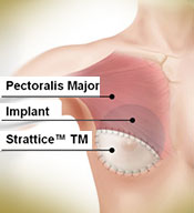 Internal Breast Support  Sanctuary Plastic Surgery