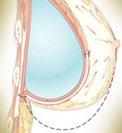 The internal bra can be used in many cases: supporting breast tissue,  holding up implants, or bringing implants closer together. The…