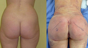 butt augmentation 