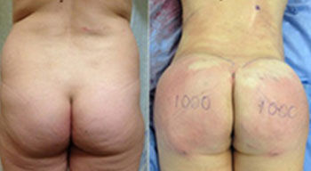 butt augmentation 