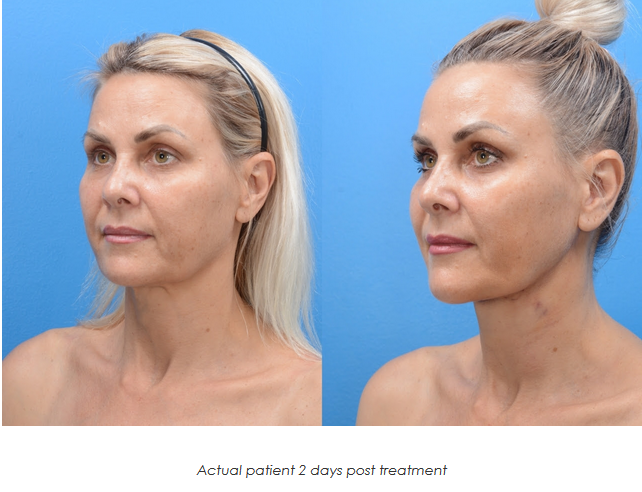 MyEllavate Before & After