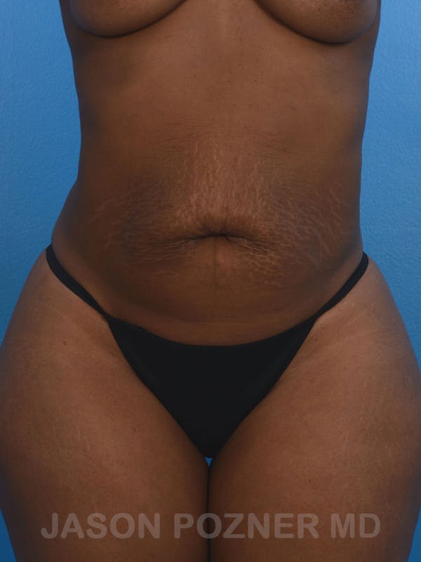 Tummy Tuck Before & After Gallery - Patient 17932022 - Image 1