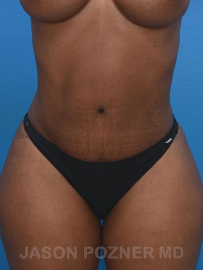 Tummy Tuck Before & After Gallery - Patient 17932022 - Image 2