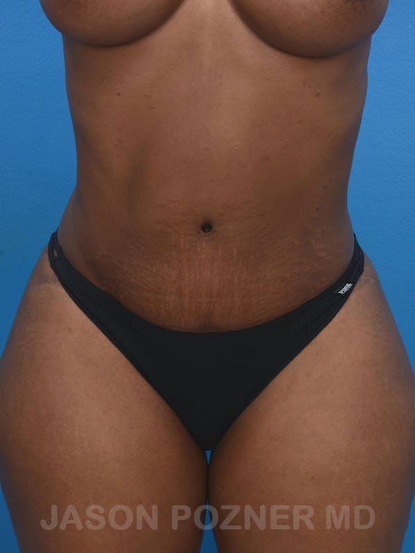 Tummy Tuck Before & After Gallery - Patient 17932022 - Image 2
