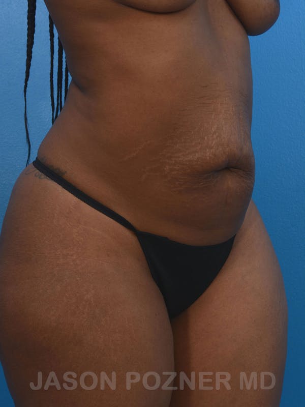 Tummy Tuck Before & After Gallery - Patient 17932022 - Image 3