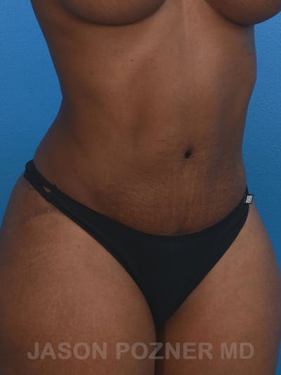 Tummy Tuck Before & After Gallery - Patient 17932022 - Image 4