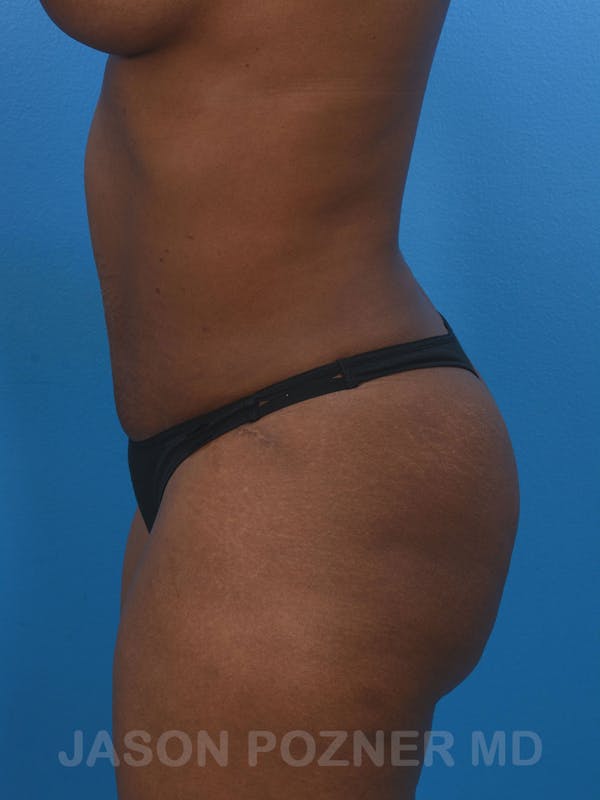 Tummy Tuck Before & After Gallery - Patient 17932022 - Image 6