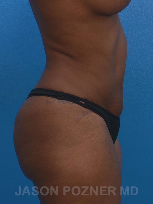 Tummy Tuck Before & After Gallery - Patient 17932022 - Image 8
