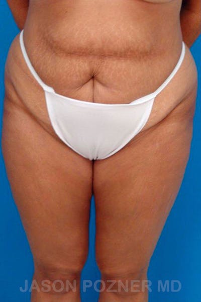 Tummy Tuck Before & After Gallery - Patient 17932024 - Image 1