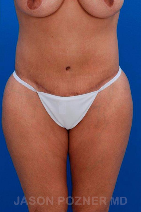 Tummy Tuck Before & After Gallery - Patient 17932024 - Image 2