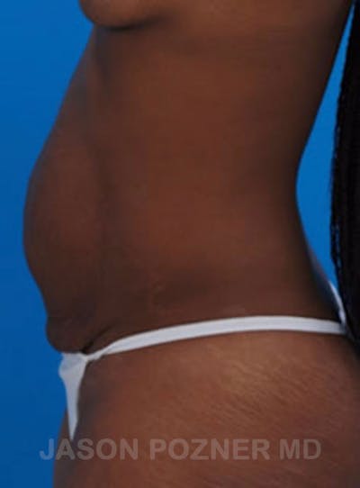 Tummy Tuck Before & After Gallery - Patient 17932029 - Image 1