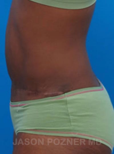 Tummy Tuck Before & After Gallery - Patient 17932029 - Image 2