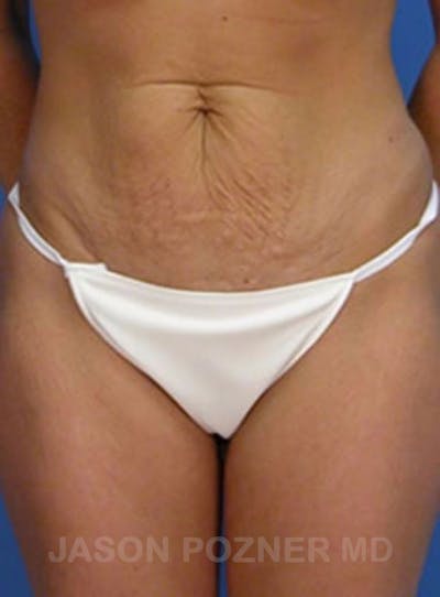 Tummy Tuck Before & After Gallery - Patient 17932030 - Image 1