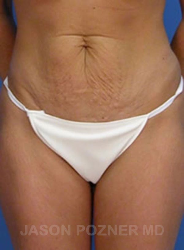 Tummy Tuck Before & After Gallery - Patient 17932030 - Image 1