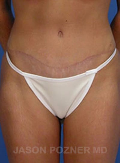 Tummy Tuck Before & After Gallery - Patient 17932030 - Image 2