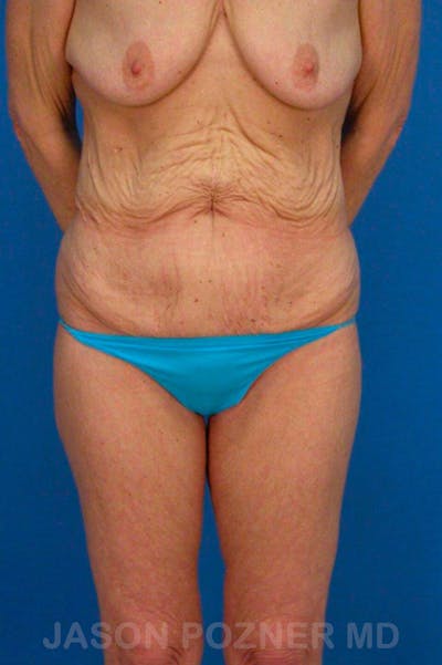 Body Lift Before & After Gallery - Patient 17932069 - Image 1