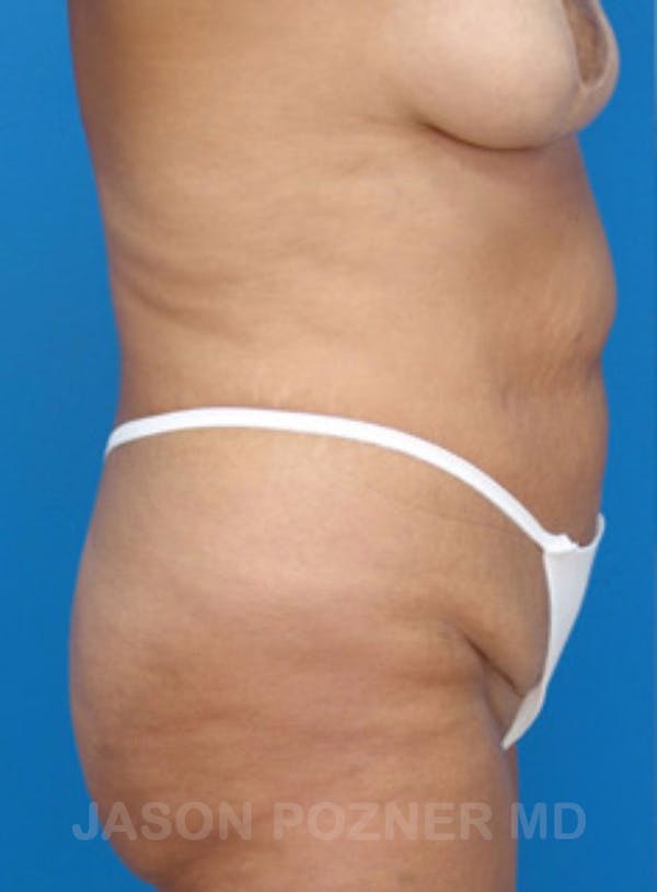 Body Lift Before & After Gallery - Patient 17932073 - Image 1