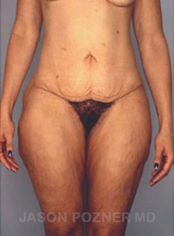 Body Lift Before & After Gallery - Patient 17932075 - Image 1